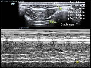 M-mode measurement of diaphragm thickness variation of the right hemidiaphragm. The diaphragm is seen as 3 parallel lines: 2 hyperechogenic layers and a thicker, central hypoechogenic layer. Number 1 is the inspiratory thickness and number 2 is the expiratory thickness. Diaphragm shortening fraction is the difference between the inspiratory thickness and the expiratory thickness.