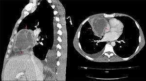Chest CT. Anterior mediastinal mass with necrotized areas of infected embryonic remnants.