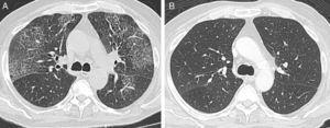 (A) Chest high-resolution computed tomography showing bilateral ground glass opacities and interlobular septal thickening. (B) Chest high-resolution computed tomography after corticosteroid treatment, showing resolution of the pulmonary lesions.