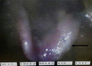 Videolaryngoscopy prior to treatment of TB.