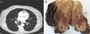 (A) Heterogeneous pulmonary consolidation in the right lower lobe, with no evidence of central lesion, associated with mural thickening. (B) Acute and chronic inflammation, forming focal abscesses, associated with a foreign body (fish bone), with Actinomyces superinfection, fibrosis and perilesional reactive changes.