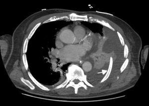 Cross-sectional slice from the chest computed tomography, showing a segment of the left rib piercing the lung (arrow) with associated hemithorax.