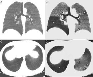 (A) minIP coronal reconstruction of the chest inspiratory CT showing homogeneous pulmonary parenchyma with uniform attenuation. (B) minIP coronal reconstruction of chest expiratory CT, showing a mosaic pattern of the pulmonary parenchyma, with areas of low density (asterisk), alternating with areas of greater attenuation. Low density areas (affecting particularly the right lower lobe and the left lung in a patchy pattern) correspond to areas of air trapping, while the areas of greater density correspond to normal pulmonary parenchyma. (C) minIP axial reconstruction of the chest inspiratory CT showing homogeneous pulmonary parenchyma. (D) minIP axial reconstruction of chest expiratory CT, showing areas of low density (asterisks), related with areas of air trapping.