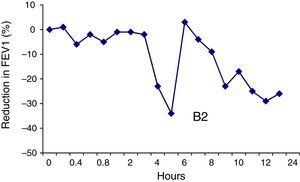 Result of specific bronchial provocation test with zinc. A late-onset reduction in FEV1 of 23% from baseline was observed after inhalation of zinc sulfate at a concentration of 0.1mg/ml for 5min, requiring administration of a ß2-agonist (B2).