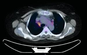 PET/CT with hypermetabolic focus in the right lower paratracheal lymph node station (4R).