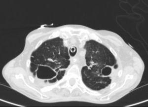Chest computed tomography: fibrocavitary tracts in both upper fields, with signs of air trapping, panlobular emphysema, nodular opacities in both lungs, and bilateral pleural thickening.