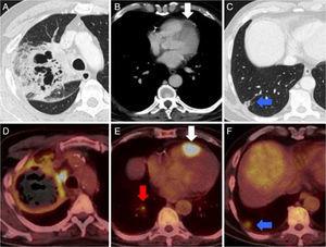 (A–C) Chest CT after administration of intravenous iodized contrast, lung (A and C) and mediastinum (B) windows. (D–F) PET/CT after administration of 18F-FDG. Mass in right upper lobe with large areas of necrosis and cavitation (A) with increased peripheral glucose metabolism (D). Lesion in the apex of the right ventricle (B and E, arrow) suggestive of cardiac metastasis. Image of peripheral base nodule containing air space in the right lower lobe (C, arrow) suggestive of pulmonary infarction. This lesion was metabolic on the PET/CT (F, arrow), and a hypermetabolic arterial embolism was observed in the feeding artery of that segment (E, gray arrow) consistent with tumor embolism.