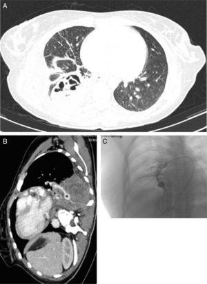 (A) Chest CT with contrast medium (parenchymal window), showing a lung abscess associated with necrotizing pneumonia of the right lower lobe. (B) Sagittal chest CT slice (mediastinal window), showing a mycotic aneurysm in the infero-medial segmental branch (asterisk). (C) Pulmonary arteriography performed before embolization of the aneurysm.
