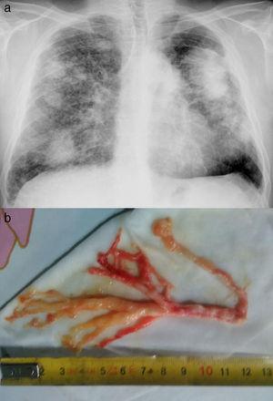 (a) Interstitial pattern with bilateral conglomerates and (b) expectorated bronchial cast.
