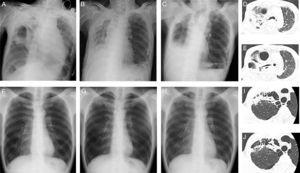 Chest X-ray images on admission (A), 1 month after admission (B), and 2 months (C) after discharge and chest computed tomography images (D, E) in Case 1. Chest X-ray images at routine medical check-up (F) and 4 (G) and 8 (H) months after routine medical check-up and chest computed tomography images (I, J) in Case 2.