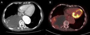 Computed tomography (CT) showing a 10.6cm mass in the right lower lobe with calcified walls, compatible with a bronchogenic cyst (A). PET-CT showing an ametabolic mass with mild increased uptake in the peripheral area (B).