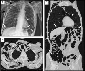 (A) Portable chest radiograph showing extensive subcutaneous tissue emphysema of the cervical and thoracic region (black arrows), with pneumomediastinum (arrow head) and pneumoperitoneum (white arrows). (B and C) Chest-abdominal computed tomography axial image and coronal plane reconstruction with lung window, showing, as in the chest radiograph, subcutaneous tissue emphysema dissecting the muscle planes of the cervicothoracic region (black arrows), minimal left apical laminar pneumothorax (black arrow head), pneumomediastinum (white arrow head), and moderate pneumoperitoneum (white arrows), with no evidence of perforated hollow viscus.
