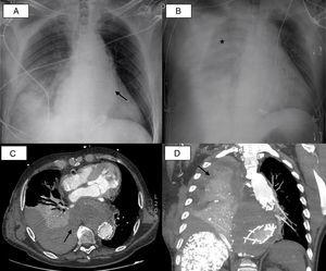 (A) Anteroposterior chest X-ray at admission: cardiomegaly, aortic elongation with stent (arrow) and area of increased density in the right thoracic base probably related to infectious disease. (B) Anteroposterior chest X-ray after clinical worsening: significant pleural effusion with opacities in the right hemithorax (asterisk). (C) Chest CT in axial plane. (D) Chest CT in sagittal plane: endoleak can be seen in the descending thoracic aorta with extravasation in the form of active bleeding into the right pleural cavity causing significant hemothorax (arrows), collapsing the entire right lower lobe and the posterior segment of the upper lobe (aortopleural fistula).