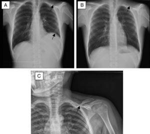 Chest X-ray: (A) Subpulmonic pleural effusion (elevation of the left pseudo-hemidiaphragm with increased distance between the pseudo-hemidiaphragm and the gastric bubble with lateral shift of the peak of the left pseudodiaphragm), as well as absence of the left clavicle (arrows). (B) After evacuation by thoracentesis. (C) X-ray obtained 6 months previously showing the clavicle in the process of reabsorption. This image led to the mistaken diagnosis of pseudarthrosis.