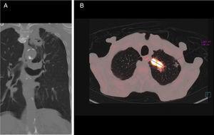 (A) Coronal CT with lung window: cavitating mass with thick irregular wall, 18mm in the left upper lobe extending toward the mediastinum. (B) Axial PET-CT: mass showing high uptake of fluorodeoxyglucose, with a standard uptake value of 28.38 units.