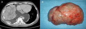 (A) Chest CT, mediastinal window. (B) Surgical specimen.