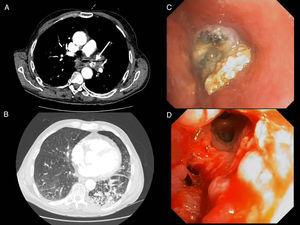 Chest CT-angiogram showing foreign body in left principal bronchus (A) and distal alveolar infiltrate in the left lung base (B). Bronchoscopic images showing foreign body occupying left principal bronchus, surrounded by significant granulomatous reaction (C), and image after extraction of the foreign body, with a completely clear bronchial lumen (D).