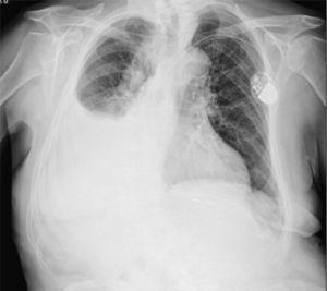 Posteroanterior chest radiograph. Large right pleural effusion. Intracavitary pacemaker.