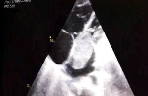 Echocardiography showing a large mass in the left atrium (6.3×3.2cm) in diastole protruding into the left ventricle.