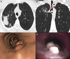 (a) Chest CT: cavitated lesion in the right upper lobe, associated with peripheral “tree-in-bud” micronodular pattern. (b) Several nodular thickenings are observed in the airway (arrow heads). (c) Virtual bronchoscopy: nodular lesions in the trachea. (d) Bronchoscopy: whitish soft-looking lesions attached to the posterior wall of the trachea.