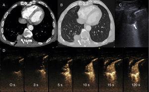 (A and B) Chest CT after intravenous administration of iodinated contrast medium, in the mediastinal window (A) and lung (B), showing a subpleural solid nodule (white arrow) with adjacent pleural thickening (black arrow) and bronchovascular incurvation (gray arrow). (C) Chest B-mode ultrasound: rounded consolidation (white arrow) associated with focal pleural thickening (black arrow). (D) Series of contrast-enhanced ultrasound images (time since administration of contrast appears in each image), demonstrating rapid uptake, earlier than 6seconds, that immediately becomes homogeneous and is not eliminated after more than a minute.