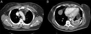 Pseudonodular image in the space between the first and second left costal arch (arrow), and simultaneous consolidation in the left lower lobe.