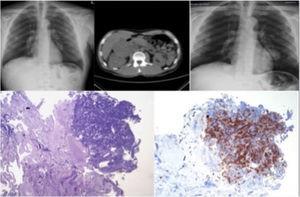 Top left, patient's chest X-ray; center, CT image showing adrenocortical mass; right, chest X-ray showing rapid progression of lung lesion; bottom row, pathology images of adrenocortical carcinoma, inhibin positive, and CK7, TTF-1 and napsin negative.