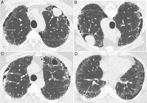 Chest CT images showing peripheral cysts pattern with honeycomb at the lung bases with an intracavitary nodule positioned anteriorly in the upper left lobe (A) that shifts position when the patient's decubitus is changed (B) (arrows). In C and D, small intracavitary nodules are visible inside cysts in the right lung (arrows).