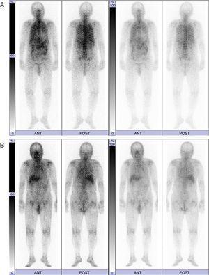 67Ga scintigraphy findings before (A) and 3 months after the administration of antituberculosis drugs (B).