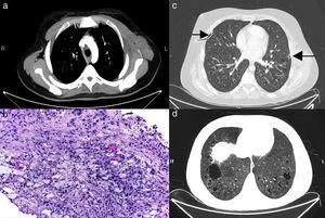 (a) Axial CT image demonstrating a large soft tissue mass in the left chest wall (asterisk). (b) Chest wall mass histological section confirming xanthomatous CD68-positive, CD1a/S100-negative foamy histiocytes with positive BRAF-V600E. (c) Axial CT image showing thorax drainage tubes due to bilateral pneumothoraces (arrows). (d) Note the striking interstitial involvement of both lungs with multiple lung cysts and diffuse thickening of the pulmonary interstitium.