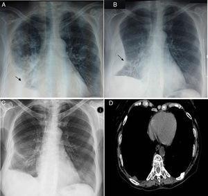 Mujer de 66 años con lupus eritematoso sistémico que presenta neumonitis lúpica aguda. (A) Radiografía de tórax que muestra derrame pleural derecho (asterisco) y consolidación pulmonar en el lóbulo superior derecho. (B) En la radiografía de tórax, tres días después, se observa un derrame pleural encapsulado derecho (asterisco). (C) Práctica desaparición del derrame encapsulado en el estudio torácico dos meses después, con un engrosamiento de la pleura costal derecha y un seno costofrénico lateral. (D) Corte axial del estudio de tomografía computarizada a los 6 meses, a nivel de las bases pulmonares con ventana de mediastino era normal.