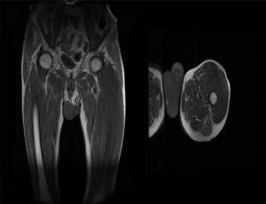A musculoskeletal MRI images: on the left, a coronal slice and on the right a sagittal slice, showing the extension of tumor.