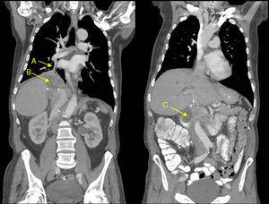 Multiplanar coronal CT reconstruction slices with intravenous contrast medium. (A) Fistulous tract between the biliary tree and the bronchus of the right lower lobe. (B) Right subphrenic collection. (C) Subhepatic collection.