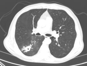 Chest computed tomography. Pseudonodular cavitary lesion, measuring 35mm in its longest diameter, in the upper segment of the right lower lobe, and multiple adjacent centrilobular and ground glass opacities.