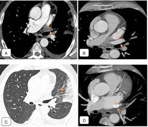 (A) Chest CT angiogram 4 months after ablation, showing total occlusion of the left superior pulmonary vein, the lumen of which is occupied by material that shows mild enhancement (arrows), that probably corresponds to inflammatory tissue. Moderate-sized left pleural effusion. (B) Pre-ablation chest CT angiogram. Axial image of a region similar to that of (A). Left superior pulmonary vein is permeable with normal caliber (arrows). (C) Chest CT of pulmonary parenchymal window: alveolar consolidation in left upper lobe and lingula, coinciding with the drainage territory of the obstructed left superior pulmonary vein, consistent with venous infarction (arrow). (D) Follow-up CT angiogram after angioplasty. Stent restoring patency observed in left superior pulmonary vein (arrows).