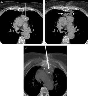(A) Axial chest CT image showing an anterior mediastinal mass (asterisk). The white line indicates the theoretical path of the biopsy from the anterior chest wall to the mediastinal mass, traversing the pleural surface and the left pulmonary parenchyma. (B) Axial chest CT image showing the creation of a small fluid collection (arrows) between the anterior chest wall and the mediastinal mass. (C) Axial maximum intensity projection CT image of chest showing the biopsy needle crossing the fluid collection (L) and penetrating the mediastinal mass (M).