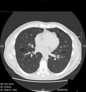 Bilateral lung cysts.