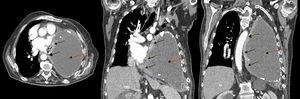 Chest CT with contrast medium, axial (left) and coronal slices (center and right): pleural mass in the medial portion of the anterior left chest wall with pericardial infiltration (solid arrows), and a large collection in the left hemithorax, corresponding with chronic pyothorax (dotted arrows), together causing contralateral mediastinal shift and cardiac compression.