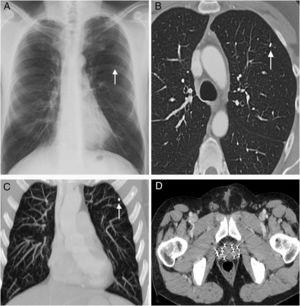 (A) Posteroanterior chest radiograph shows a small metallic density in the left lung (arrow). (B) and (C) Axial (B) and coronal MIP (maximum intensity projection), (C) CT images (lung window) confirm that the metallic density corresponds to a single migrated brachytherapy seed in the left upper lobe (arrow). (D) Axial CT image at the level of the pelvis shows multiple brachytherapy seeds within the prostate.