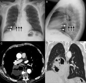 (A) Posteroanterior chest X-ray showing opacity in the right hemithorax (white arrows) containing an air-fluid level (black arrows). Note the gastric fundus (asterisk) protruding into the left subphrenic region. (B) Lateral chest X-ray confirming the retrocardiac location of the opacity (white arrows) with the air-fluid level (black arrows). (C) Axial CT image showing an extensively necrotic, cavitary mass (asterisk) in the paramediastinal region of the right lower lobe. Note the presence of an air-fluid level in the cavitated area. (D) Coronal CT image (pulmonary parenchymal window) confirming intrapulmonary lesion and preserved hemidiaphragms.