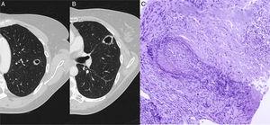 (A) Chest CT showing a cavitating nodular lesion in the left upper lobe and (B) another in the upper segment of the lingula. (C) Staining of elastic fibers to highlight the irregular destruction of the arterial wall by the inflammatory process. Necrosis is seen in the upper right corner. Orcein 200×.