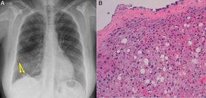 (A) Chest X-ray showing two right supradiaphragmatic nodules (arrows). (B) Hepatic tissue with mild steatosis, immersed in a fibroconnective tissue coated with mesothelial cellularity (diaphragmatic parietal pleura) (H&E 20×).