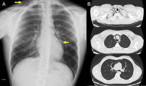 (A) Chest X-ray, showing (arrows) signs of subcutaneous emphysema the right laterocervical region and an area of left paracardiac hyperlucency, suggestive of pneumomediastinum. (B) Chest CT (parenchymal window) showing extensive pneumomediastinum in several regions, dissecting the mediastinal structures.