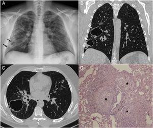 (A) Standard chest X-ray: bilateral diffuse interstitial pattern, consisting of patchy images of increased density, predominantly in the right lung field (arrows). Chest high-resolution computed tomography (HRCT). (B) Coronal reconstruction. (C) Axial image, both with lung window: interstitial micronodular pattern with perilymphatic distribution, cavitary nodules with a thick, smooth wall (arrows) and bilateral hilar lymphadenopathies (asterisks). (D) Photomicrograph of transbronchial biopsy: lung parenchyma with numerous non-necrotizing granulomas (stars) with peribronchial distribution, consisting of epithelioid cells and multinucleated giant cells (hematoxylin-eosin, ×40).