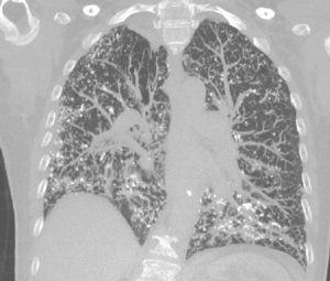 Chest high-resolution CT, coronal slice: diffuse reticulonodular infiltrate, with calcifications in some lesions.