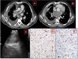 (A and B) CT scan showing the left atrial mass invading the right pulmonary artery. (C) EBUS image showing subcarinal area (*) and left atrial mass (+). (D and E). Histology of biopsy from the subcarinal area. The spindle cells are ERG(D) and Fli1(E) positive.