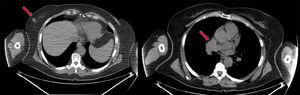 CT slice of breast lesion and mediastinal disease.