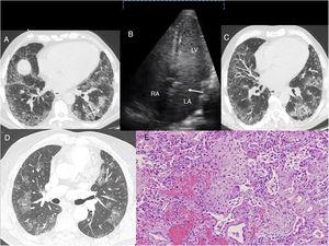 (A) Case 1: chest HRCT axial slice (lung window), showing reticular interstitial involvement, with septal thickening and ground-glass opacities in the lung bases and traction bronchiectasis (arrow). (B) Case 1: Echocardiogram with agitated saline contrast showing the late passage of bubbles to the left atrium after 3–6 beats (arrow). RA: right atrium; LA: left atrium; LV: left ventricle. (C) Case 2: chest HRCT axial slice (lung window), showing subpleural reticulation with apex-base gradient, accompanied by distortion of the lung architecture and traction bronchiectasis. Areas of ground glass opacities with septal thickening are also observed. (D) Case 3: Chest HRCT axial slice (lung window) showing bilateral, patchy pulmonary ground glass opacities. E. Case 3. Histological image showing foci of bleeding with little reactive change in the alveolar epithelium. Inflammation and pneumocytic hyperplasia are also seen alternating with areas of lax fibrosis replacing the pulmonary parenchyma. These findings are compatible with acute alveolar damage (hematoxylin-eosin stain, 100×).