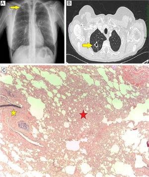 Pulmonary siliconoma. (A) Chest X-ray, PA projection, showing cavitary lesion in RUL, superimposed on clavicle and arch of the second rib. (B) Chest CT axial slice showing cavitary lesion measuring 15×16mm in RUL. (C) Histological specimen of surgical lung biopsy, hematoxylin-eosin staining 40×. Lymphohistiocytic infiltrate with multinucleated cells (red star). Foreign body, remains of silicone polymers (yellow star).