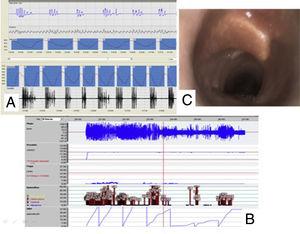 (A) Respiratory polygraphy with obstructive events. (B) AutoCPAP recording with persistent respiratory events at a fixed pressure of 14cmH2O. (C) Dislocation/rupture of subglottic tracheal visualized by fiberoptic bronchoscopy under sedation.